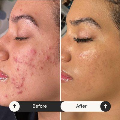 Severe acne treatment