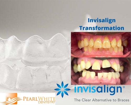 Invisalign transformation