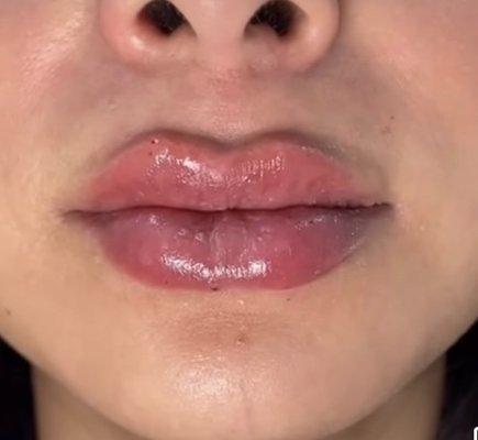 Lip fillers