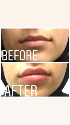 Lip filler