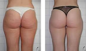 Before & After Ultrasonic Cavitation