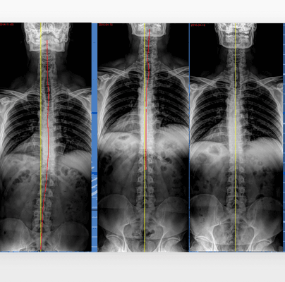 55 y/o construction worker Corrective Care 1 Year.