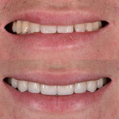 8 upper and 8 lower porcelain veneers