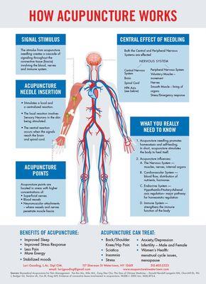 Acupuncture treatment has used over 3500 years in China, it's a natural treatment. Why no trying!