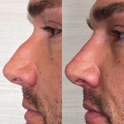 Liquid Rhinoplasty