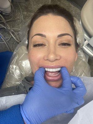 My veneers by Dr. Hecklin