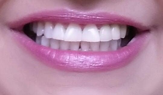 My teeth after getting them whitened for the 1st time in 49 years.