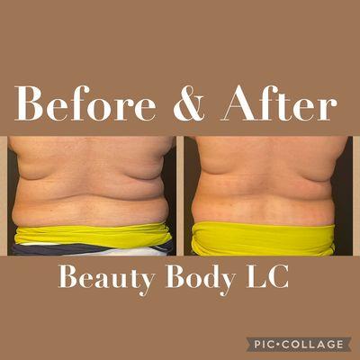 Before and after of a Lipo Cavitation session