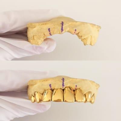 8 unit bridge - have missing or chipped teeth? We have different options to resolve/ restore missing or chipped teeth. -AB Golds