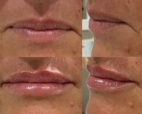 lips with Juvederm ultra