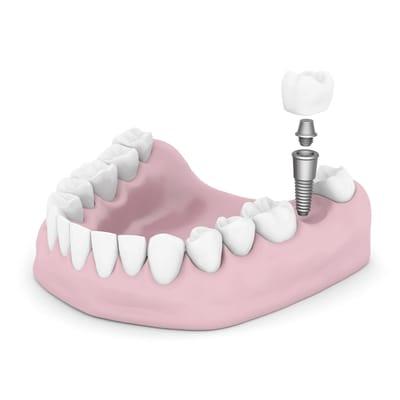 Dental implant to replace missing tooth - 24 months interest free financing available!