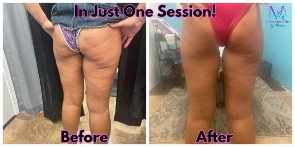 Cellulite removed after 1 session!