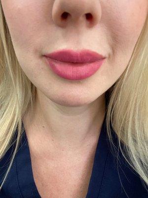 Lip augmentation and around the mouth filler