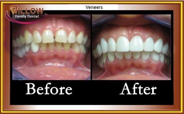 Veneers