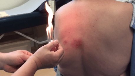 Fire needling acupuncture