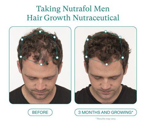 Before and after hair replacement for men