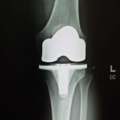 New Knee!