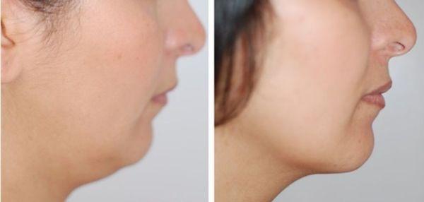 Non surgical Face shaping and lifting