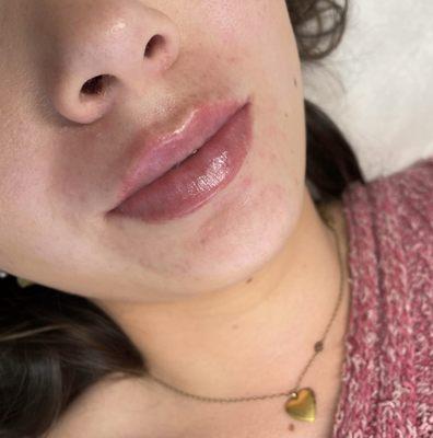 Hyaluron pen lip fillers