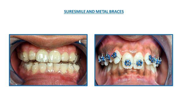 Suresmile Clear and Metal Braces.