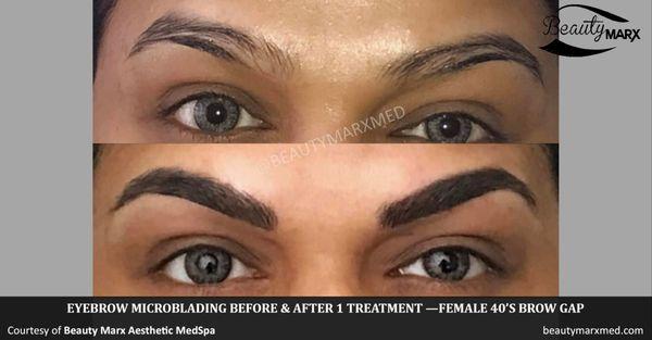 Eyebrow microblading to correct a brow gap.