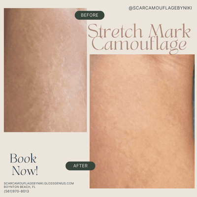 Stretch Mark Camouflage- blend and conceal for a more seemless look