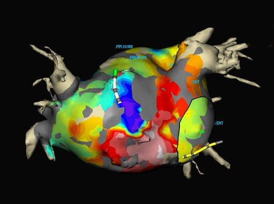 A 3-D rendering of left atrium with superimposed activation map of atrial flutter.