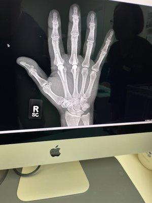 X ray new nuckles