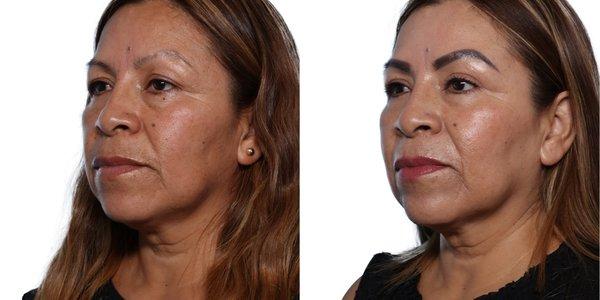 Brow Lift + Quad Blepharoplasty