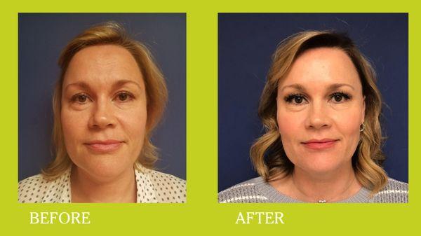 CO2 facial resurfacing on a woman in her 40's.