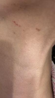 Cut marks on my skin from threading