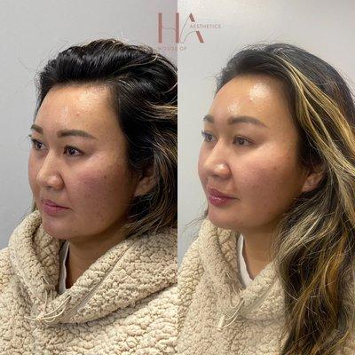 Before and after temple, midface, nasal labial folds and lip filler