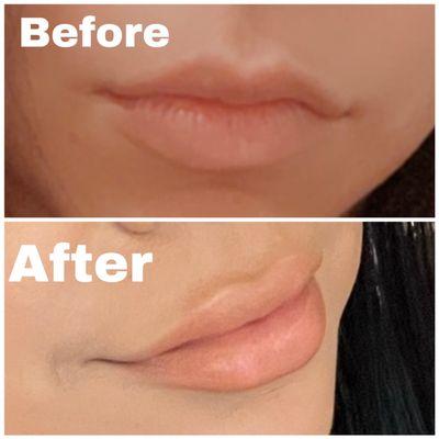 Lip filler