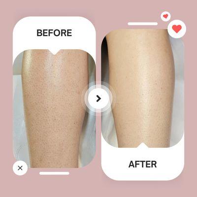 Just one session after our laser hair removal treatment