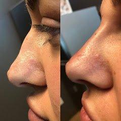 Liquid Nose job