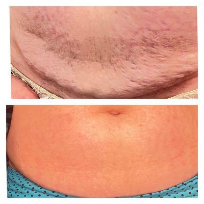 Body Contouring results after 6 Professional Treatments and a daily home regimen routine over 3 weeks.