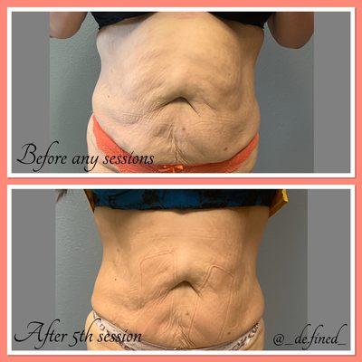 This is self explanatory But look at these results!! Just after 5 sessions!