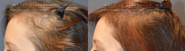 Hair restoration for females