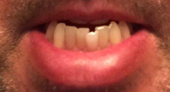 They chipped my tooth during a routine dental cleaning!!