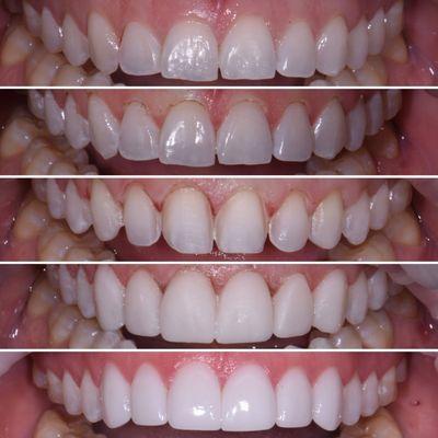 Minimal Prep Veneers. 
 Before, Laser Gum Lift, Prepped Teeth, Temporaries, Porcelain.