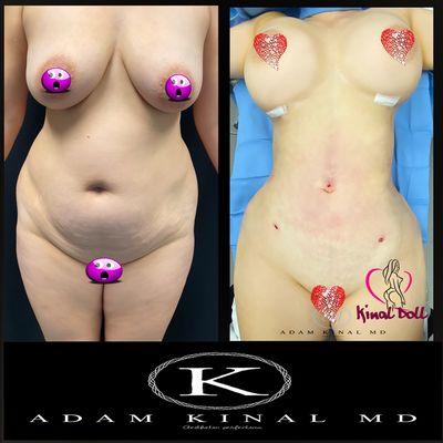 Lipo360+Plus, fat transfer to buttocks and Breast Aug