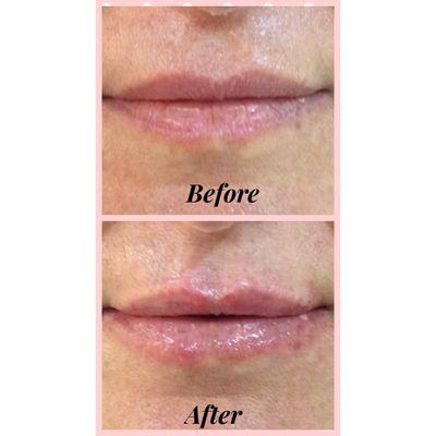 Beautiful lips are all about shape. Check out our newest filler Prollenium Versa for lip enhancement!