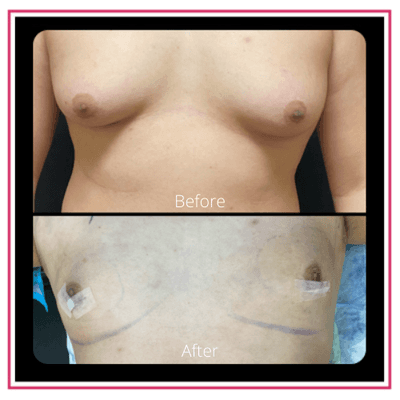 Gynecomastia (Male Breast Reduction)