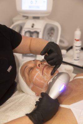 HIFU Ultrasound therapy (non surgical face lift)