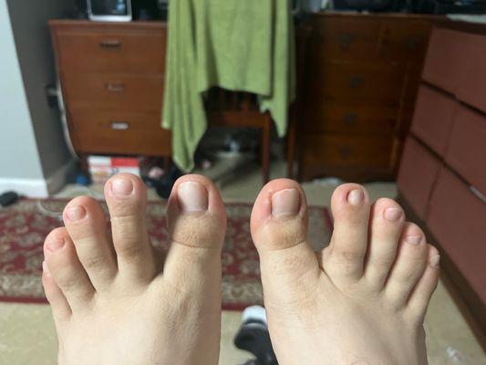 Results of the pedicure (note the toenail next to the right big toe where the pinch curve is removed)