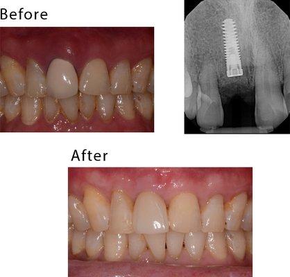 Patient had a periodontal infection, lost his front tooth. It was removed and restored with an implant-supported ceramic crown by Dr. Hong