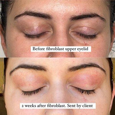 Non-Surgical Blepharoplasty with the fibroblast skin tightening procedure