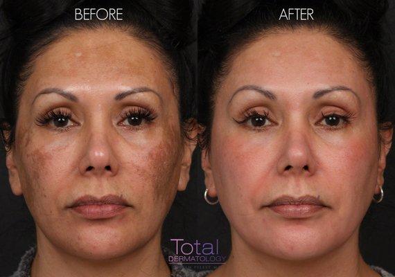 Patient was treated with Cosmelan for melasma.