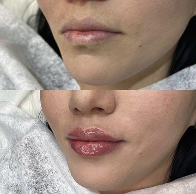 Lip filler before and after