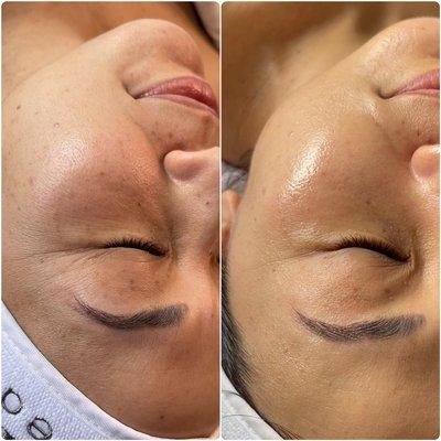 HYDROFACIAL before & after!